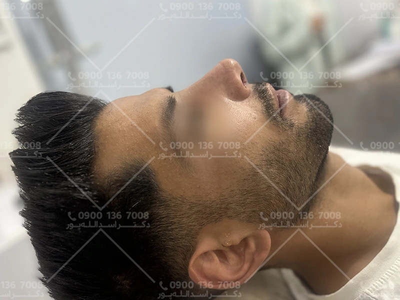 بارداری و جراحی بینی دکتر اسدالله پور