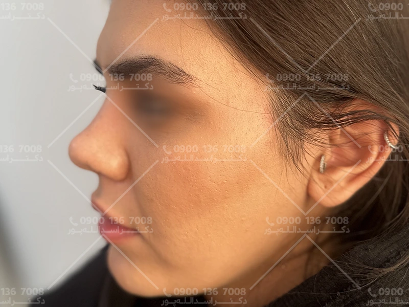 قیمت عمل بینی دکتر اسدالله پور
