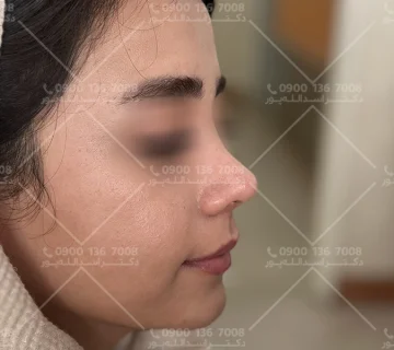 نحوه خوابیدن بعد از جراحی بینی دکتر اسدالله پور