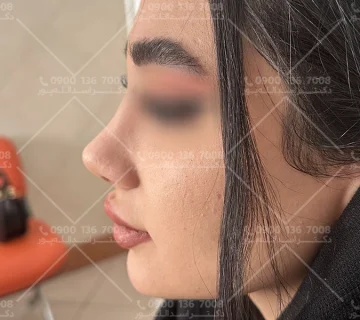 قرص آناهیل بعد از جراحی بینی دکتر اسدالله پور  