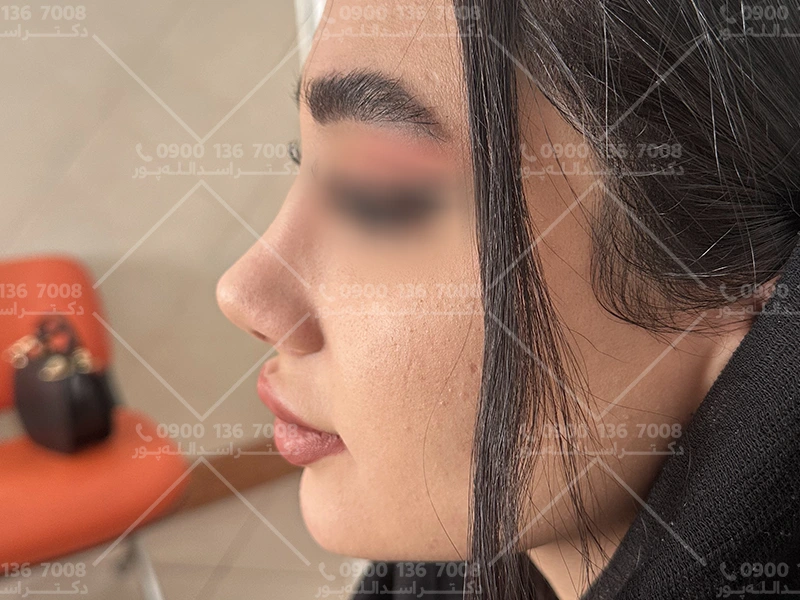 قرص آناهیل بعد از جراحی بینی دکتر اسدالله پور  