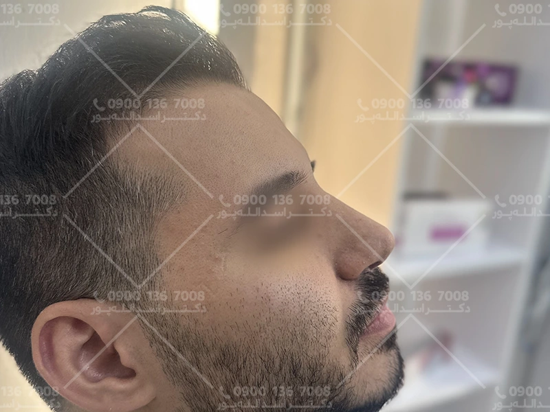 تحرک و ورزش بعد از عمل جراحی بینی دکتر اسدالله پور